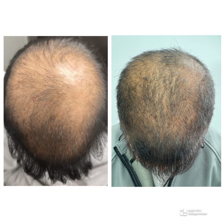 Nuestro equipo médico realizando un diagnóstico y aplicando un protocolo estético totalmente personalizado a las necesidades de la paciente.