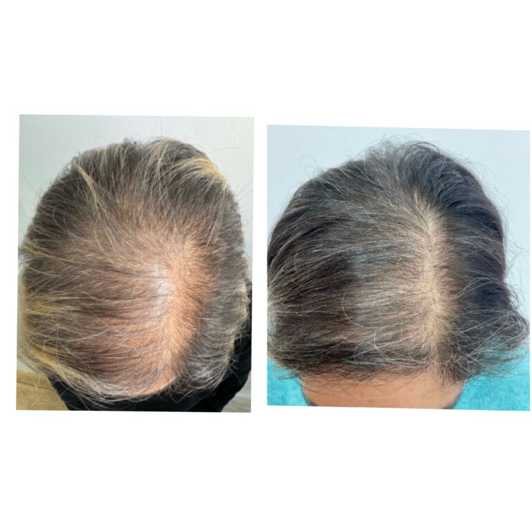 Nuestro equipo médico realizando un diagnóstico y aplicando un protocolo estético totalmente personalizado a las necesidades de la paciente.