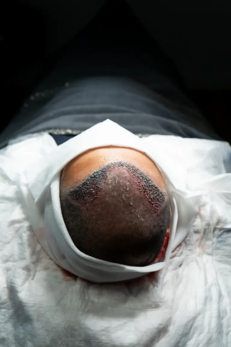 Equipo médico especialista realizando una intervención de injerto capilar a un paciente en Centro Médico Estético Lezkairu.