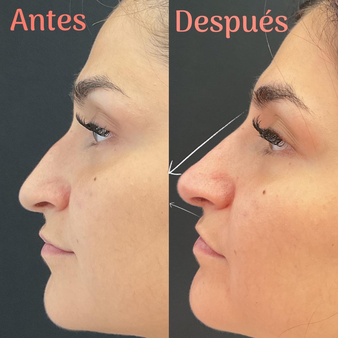 Resultados de una nariz recta, armónica y levantada antes y después de una rinomodelación estética en Pamplona.