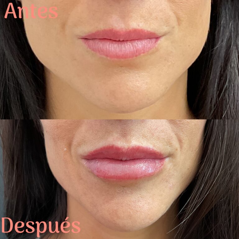 Resultados reales del antes y después de un aumento, perfilado e hidratación de labios con ácido hialurónico.