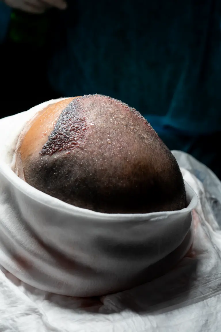 Paciente recibiendo un tratamiento médico de injerto capilar para solucionar problemas de alopecia en Pamplona.