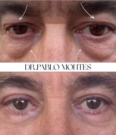 Hombre antes y después de recibir el tratamiento de blefaroplastia no quirúrgica en el centro médico estético de Lezkairu.