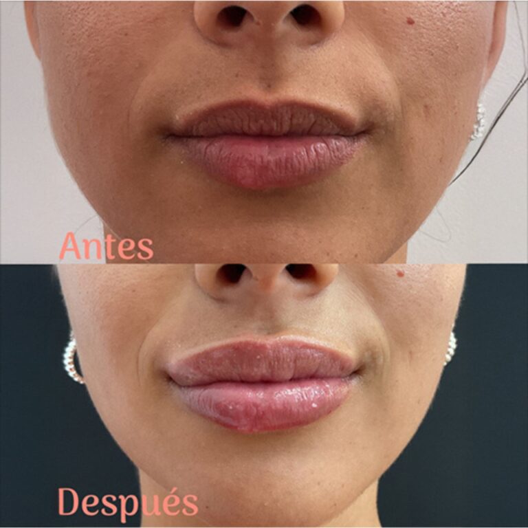 Resultados reales del antes y después de un aumento, perfilado e hidratación de labios con ácido hialurónico.