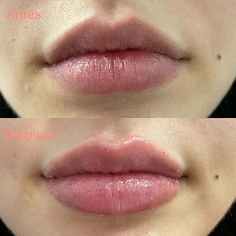 Resultados reales del antes y después de un aumento, perfilado e hidratación de labios con ácido hialurónico.