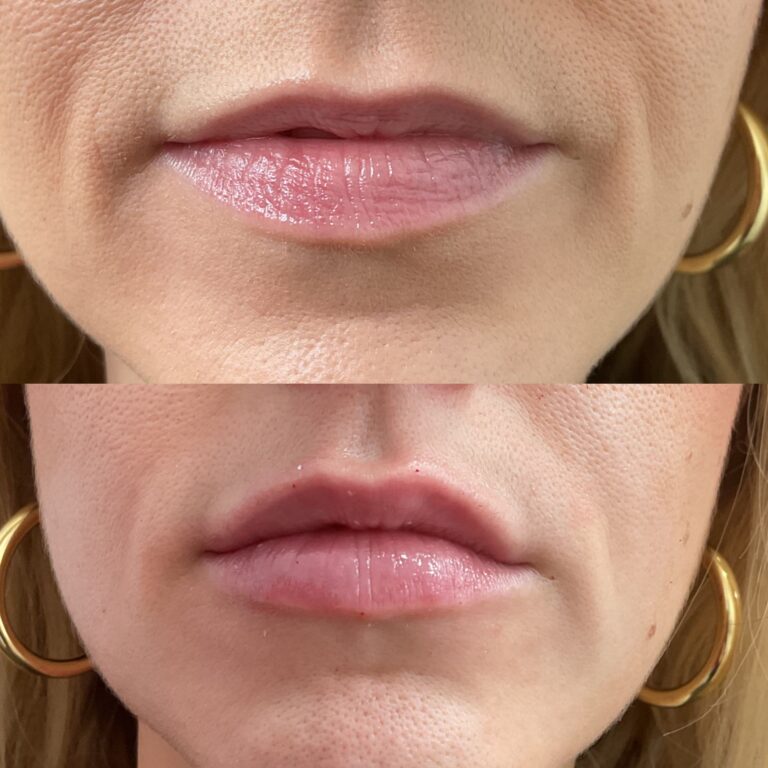 Resultados reales del antes y después de un aumento, perfilado e hidratación de labios con ácido hialurónico.