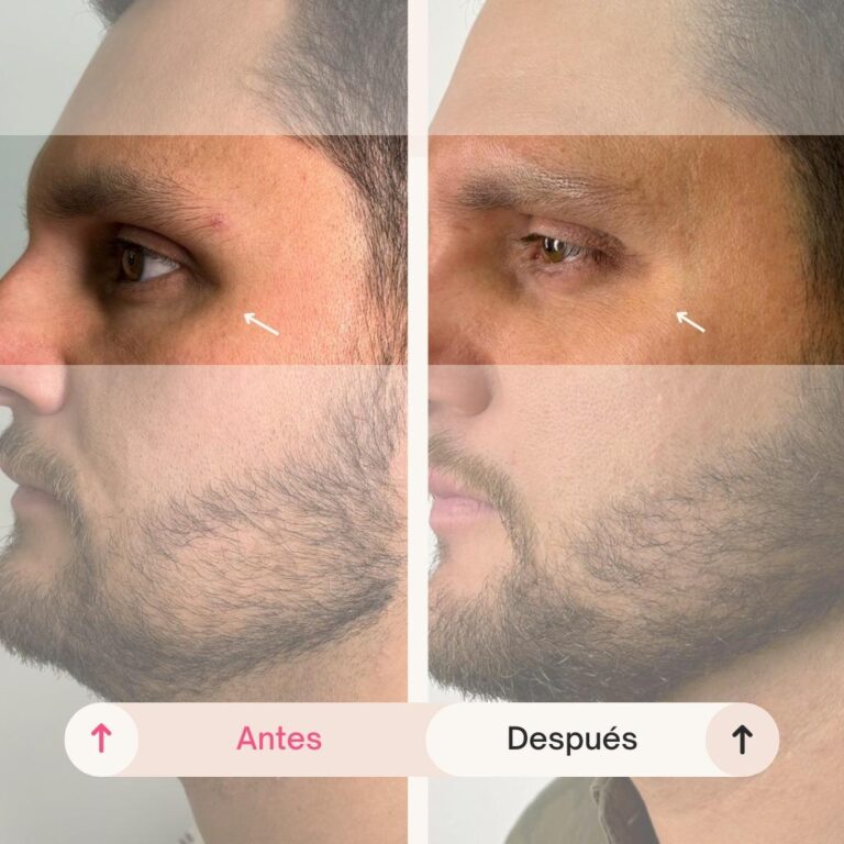 Tratamiento-de-ojeras