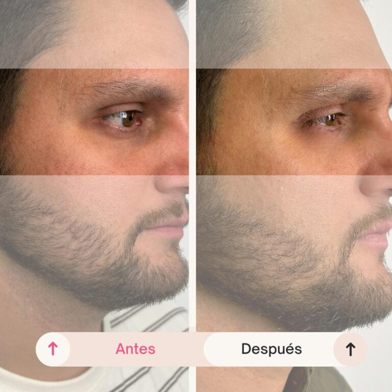 Eliminación del hundimiento, surcos y aspecto de cansancio en la mirada antes y después de un tratamiento de ojeras en Pamplona.