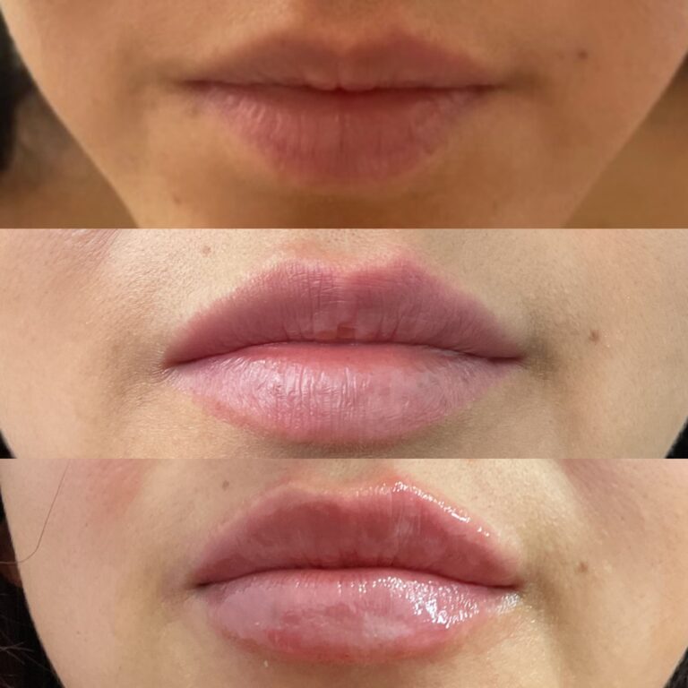 Resultados reales del antes y después de un aumento, perfilado e hidratación de labios con ácido hialurónico.