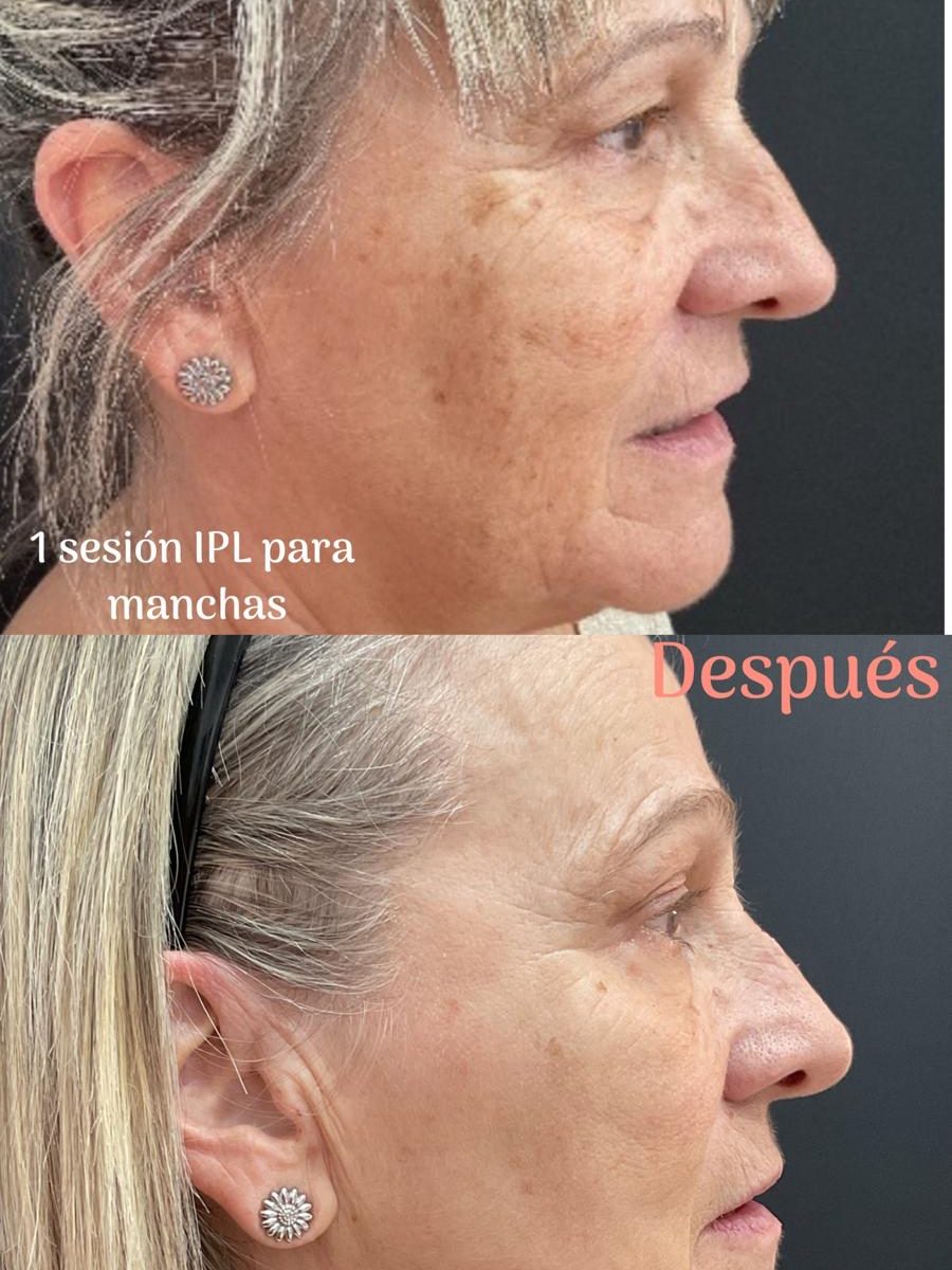 Resultados del antes y después del tratamiento facial con luz pulsada intensa (IPL) para eliminar manchas y rojeces en Pamplona.